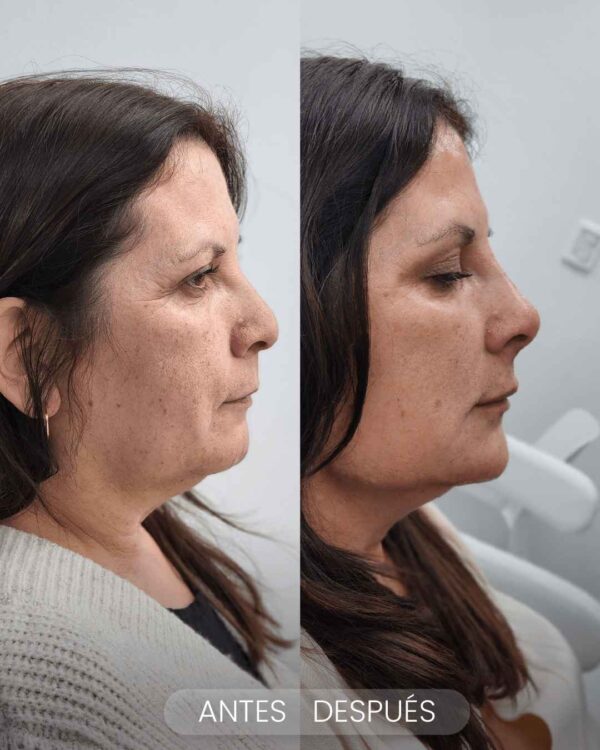 Perfilado mandibular - Imagen 5