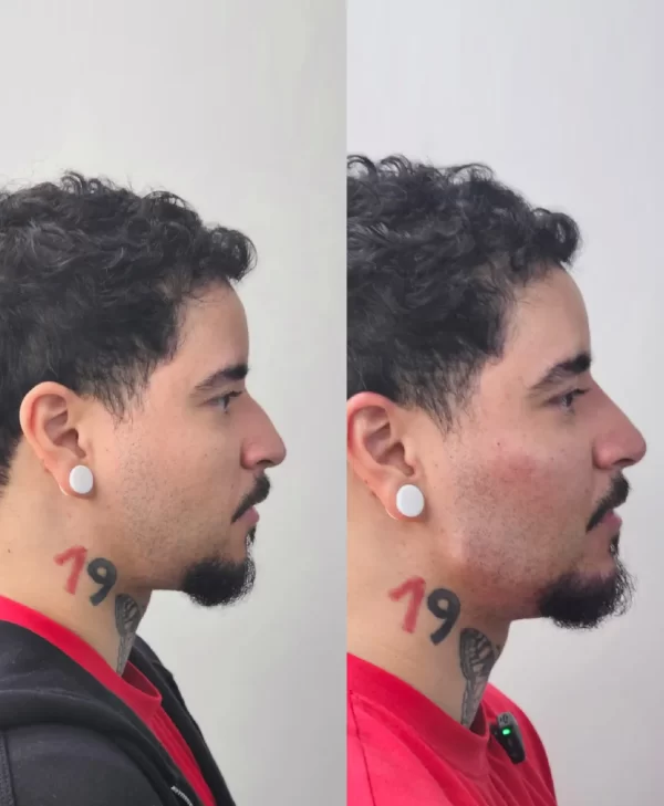 Prometeo - Masculinización facial - Imagen 4