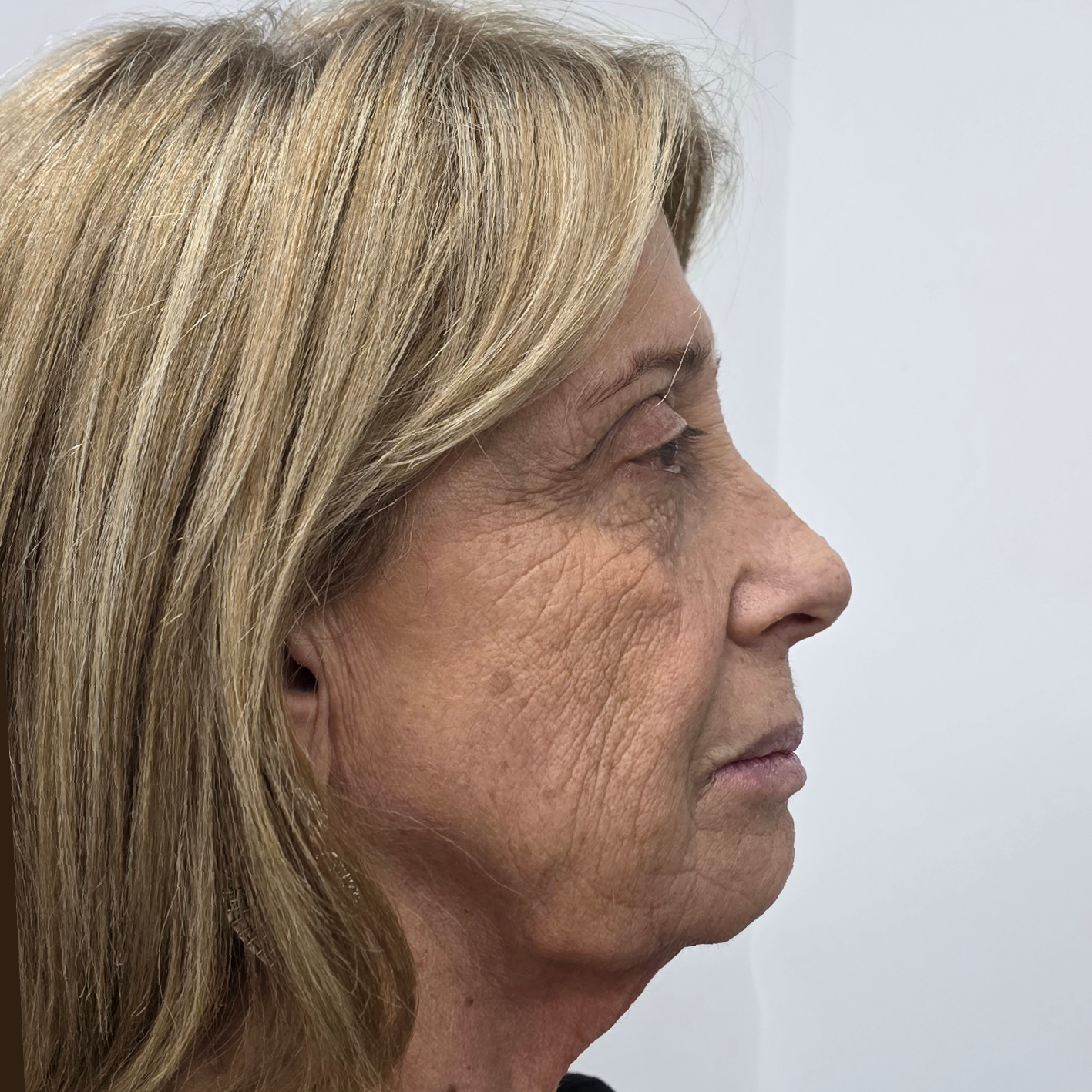 antes y despues lifting-01