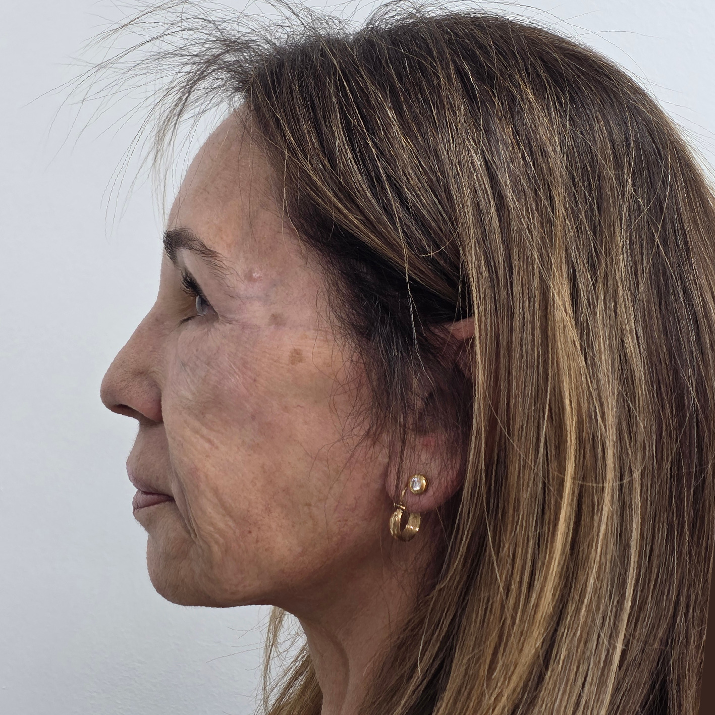 antes y despues lifting-04