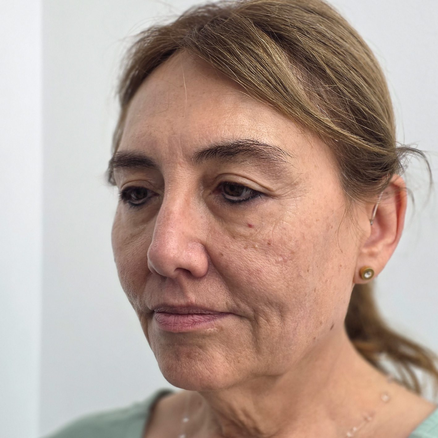 antes y despues lifting-11